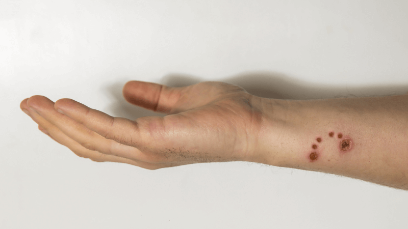 Man with dog bite marks on his wrist
