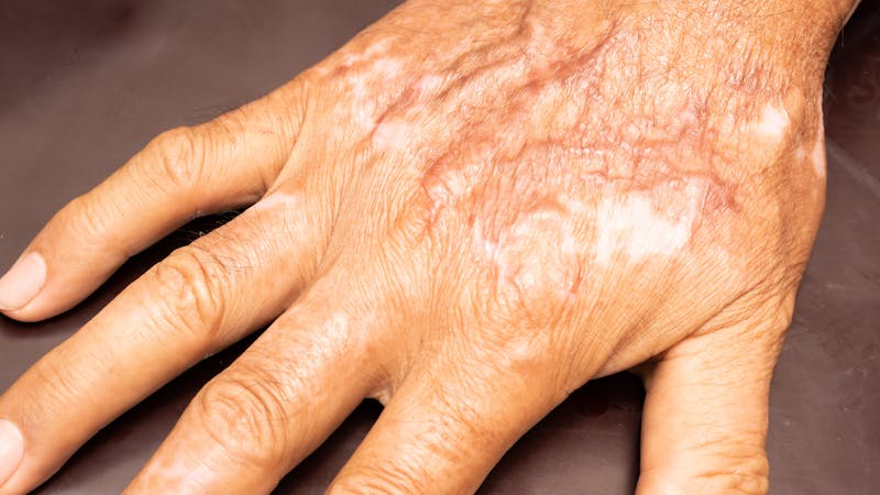 A human hand with visible scarring lies flat against a dark background, indicating signs of healing or a skin condition.