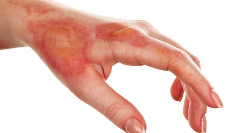 | Matz Injury Law A human hand displays red and yellow discoloration, suggesting recent burns or irritation. The fingers are slightly curled, and the overall appearance conveys pain or discomfort.