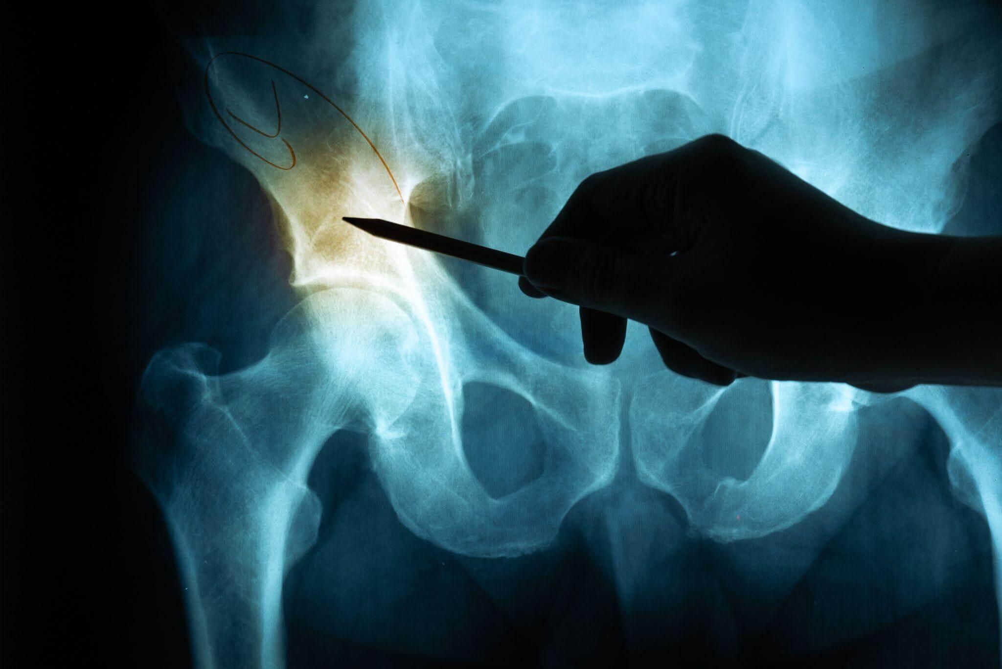 A person is reviewing an X-RAY, the area seems to be from a persons' hip