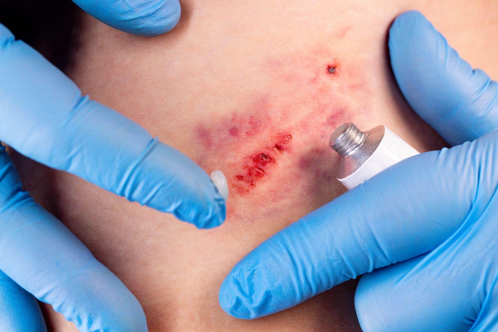 a close up of a person with gloves on tending a dog bite wound